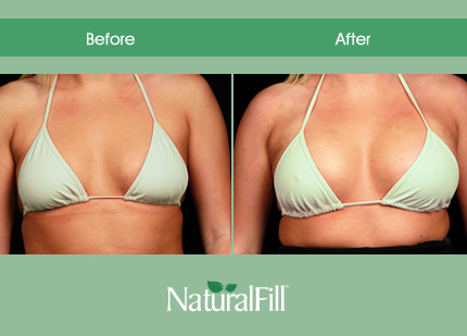 Breast Augmentation Fat Transfer 33